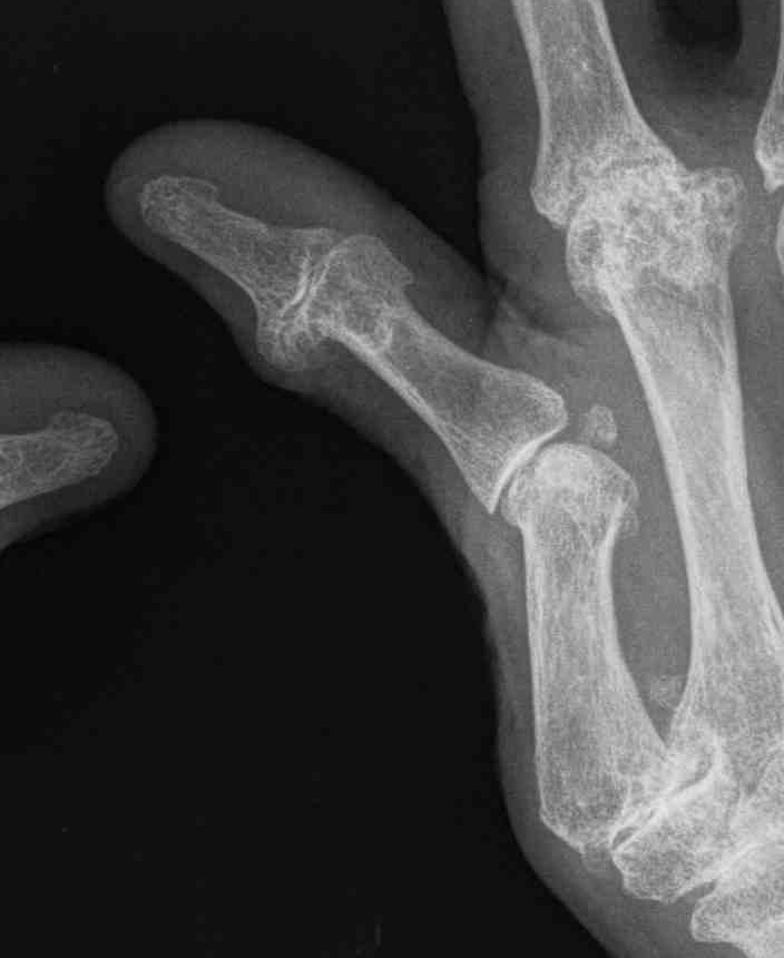 Rheumatoid Thumb Swan Neck